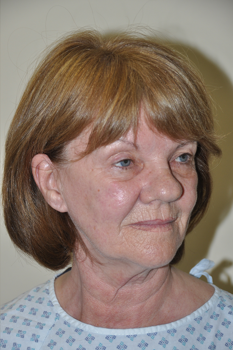 View 2 — before (pre-operative)